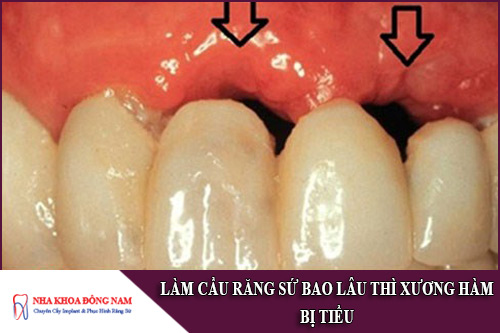 làm cầu răng sứ bao lâu thì xương hàm bị tiêu