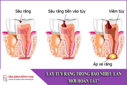 lấy tủy răng trong bao nhiêu lần mới hoàn tất