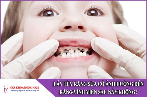 lấy tủy răng sữa trẻ em có ảnh hưởng đến răng vĩnh viễn sau này không