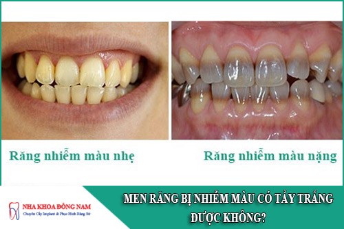 men răng bị nhiễm màu có tẩy trắng được không