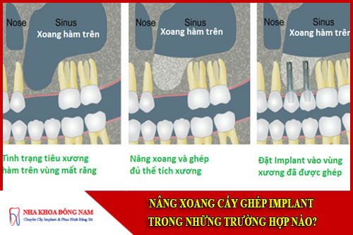 Nâng xoang cấy ghép implant trong những trường hợp nào