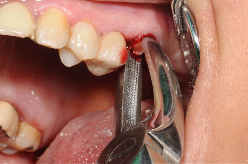 Nhổ răng thừa hỗ trợ quá trình chỉnh nha niềng răng