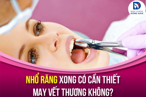 Nhổ Răng Xong Có Cần Thiết May Vết Thương Không