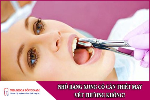 nhổ răng xong có cần thiết may vết thương không