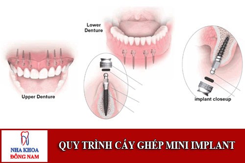 quy trình cấy ghép mini implant;