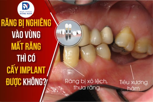 răng bị nghiêng vào vùng mất răng thì có cấy implant được không
