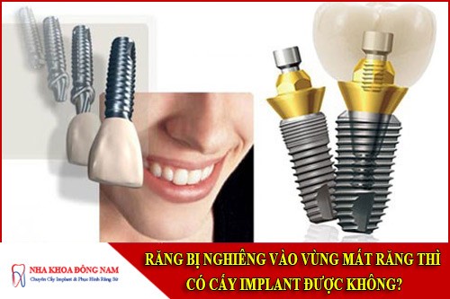 răng bị nghiêng vào vùng mất răng thì có cấy implant được không