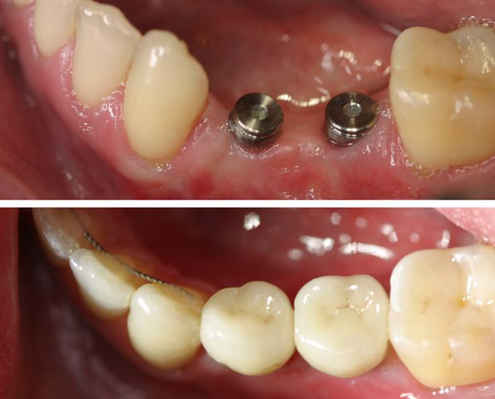 Răng Implant áp dụng cho mọi trường hợp thiếu răng bẩm sinh