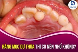 Răng Mọc Dư Thừa Thì Có Nên Nhổ Không