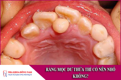 răng mọc dư thừa thì có nên nhổ không