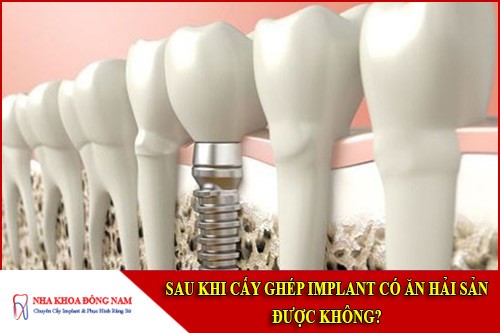 sau khi cấy ghép implant có ăn hải sản được không