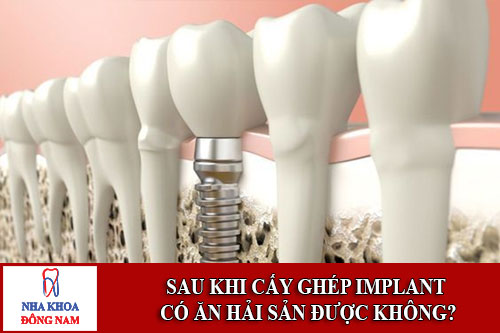 Sau khi cấy ghép Implant có ăn được hải sản không