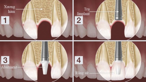 mô phỏng kỹ thuật cấy ghép răng implant