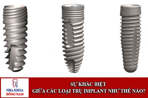 Sự khác biệt của các loại trụ Implant