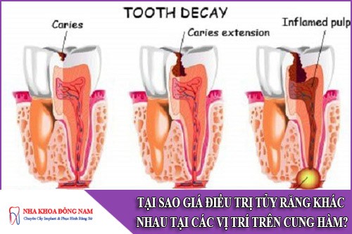Tại Sao Giá Điều Trị Tủy Răng Khác Nhau Giữa Các Vị Trí Trên Cung Hàm