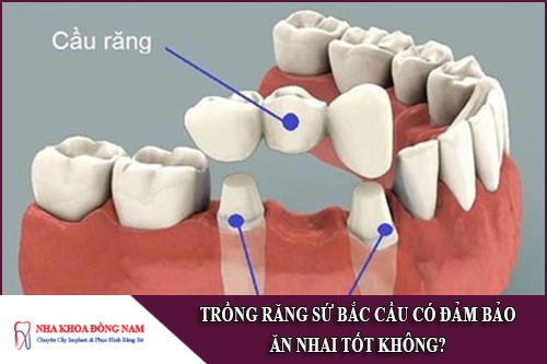 trồng răng sứ bắc cầu có đảm bảo ăn nhai tốt không