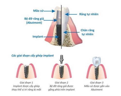 quy trình cấy ghép implant