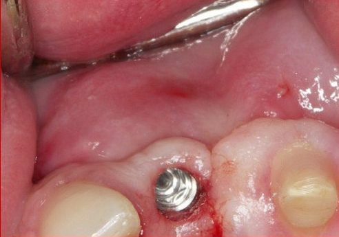 răng implant bị đào thải