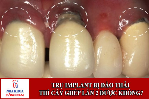 Trụ Implant bị đào thải thì cấy ghép implant lần 2 được không