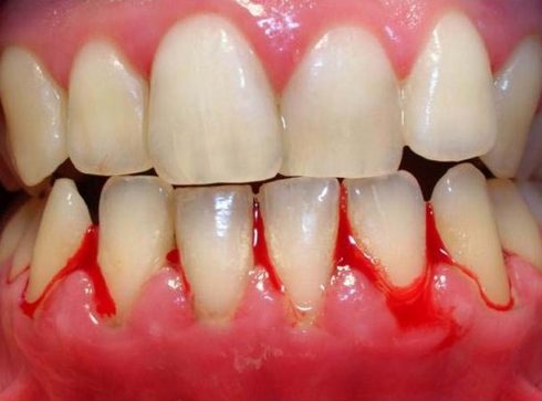 Trường hợp lưu ý không nên tẩy trắng răng 6