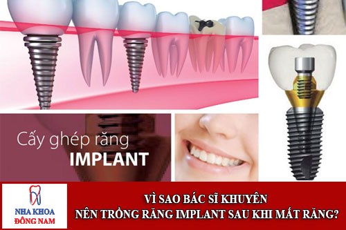 Vì sao bác sĩ khuyên nên trồng răng implant khi mất răng