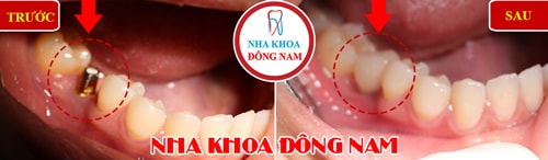 Cấy ghép 1 trụ Implant răng hàm