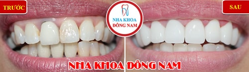 Bọc răng toàn sứ thay răng sứ kim loại