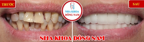 Bọc răng sứ cho răng bị ố vàng và mọc không đều