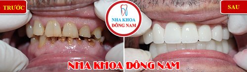 Bọc răng sứ cho răng bị hư tổn và ố vàng