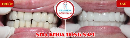 Thay răng sứ kim loại bằng răng toàn sứ