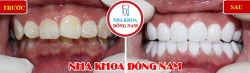 Bọc răng sứ cho răng bị hô