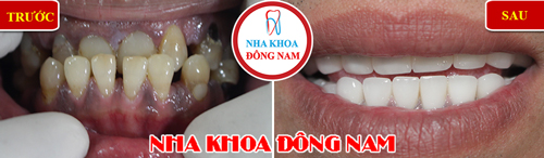 Bọc răng sứ cho răng thưa và hư tổn