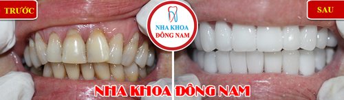 Bọc răng sứ cho răng bị khuyết cổ