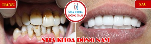 Bọc răng sứ cho răng bị khuyết cổ và vàng răng