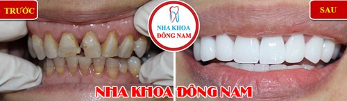 Bọc 2 hàm răng sứ Hi-zirconia cho răng bị ố vàng