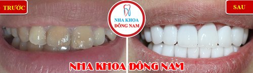 Bọc răng sứ cho răng bị nhiễm kháng sinh 3