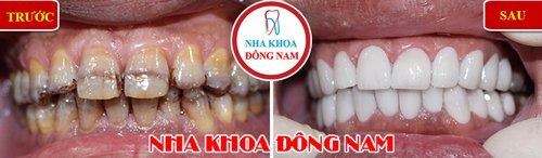 Bọc răng sứ cho răng bị ố vàng và nhiễm kháng sinh