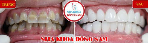 Bọc răng sứ cho răng bị nhiễm kháng sinh 6