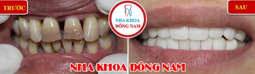bọc răng sứ cho răng bị thưa và xỉn màu