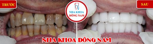 Bọc răng sứ cho răng bị ố vàng nhiễm kháng sinh nặng