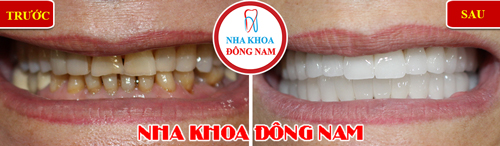 Bọc răng sứ cho răng bị ố vàng