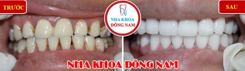 Bọc răng sứ cho răng bị ố vàng và không đều