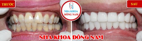 Bọc răng sứ cho răng bị ố vàng 5