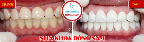 Bọc răng sứ cho răng bị ố vàng