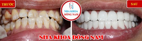 Bọc răng sứ cho răng bị vàng và lộn xộn