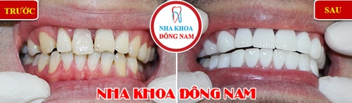 Bọc răng sứ cho răng mọc không đều