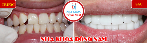 Bọc răng sứ thẩm mỹ cho 2 hàm răng