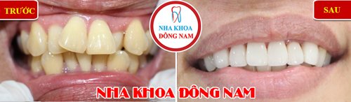 Bọc răng sứ cho răng mọc lộn xộn hàm trên