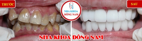 Bọc răng sứ 2 hàm cho răng bị nhiễm kháng sinh
