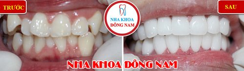 Bọc 2 hàm răng sứ cho răng mọc lộn xộn